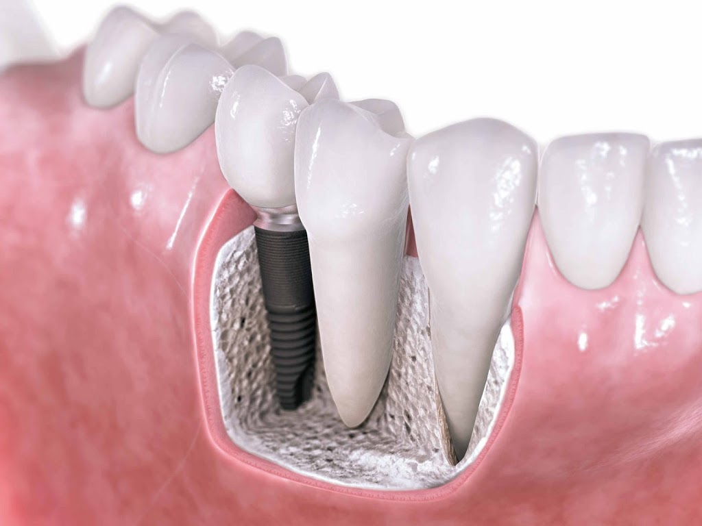 Análise fotoelástica da distribuição de tensões em implantes osseointegráveis com diferentes desenhos.