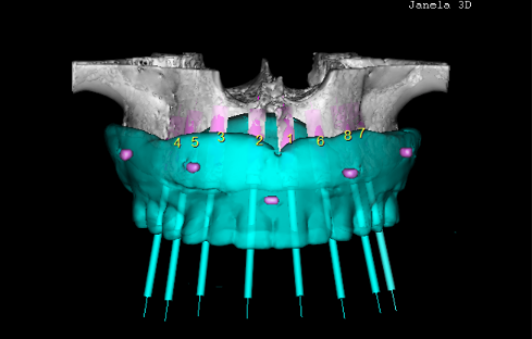 Avaliação clínica e radiográfica quanto à resposta tecidual biológica da superfície do implante osseointegrado speed em um caso de Cirurgia Guiada por C.