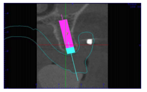 superfície speed em caso de cirurgia guiada