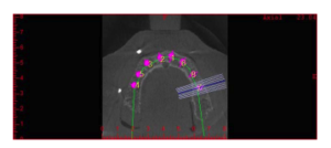 superfície speed em caso de cirurgia guiada