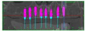 superfície speed em caso de cirurgia guiada