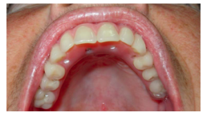 superfície speed em caso de cirurgia guiada