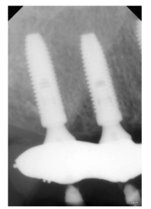 superfície speed em caso de cirurgia guiada