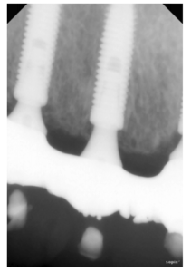 superfície speed em caso de cirurgia guiada