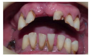 superfície speed em caso de cirurgia guiada