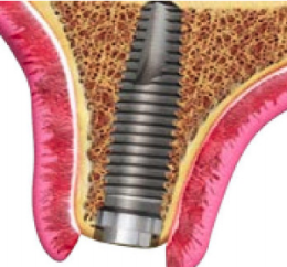 Avaliação in vitro do colar de implantes cone Morse de diferentes diâmetros sob cargas cêntrica e excêntrica: estudo por meio da Interferometria Eletrônica por Padrões de Speckle.