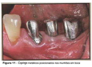 implantes de conexão sem parafuso