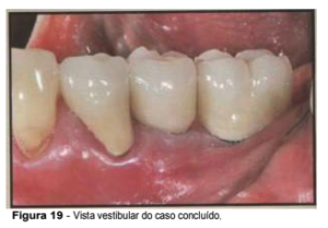 implantes de conexão sem parafuso