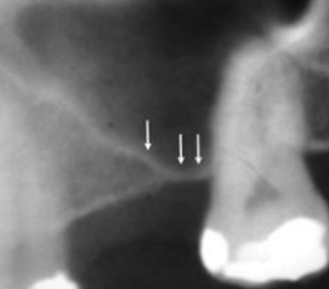 implantes de titânio curtos