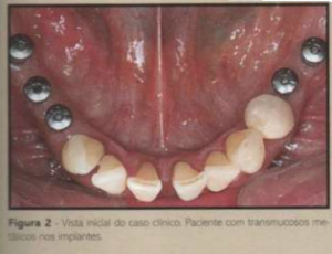 implantes de conexão sem parafuso