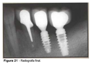 implantes de conexão sem parafuso