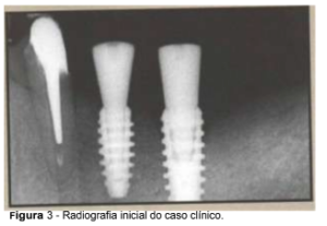 implantes de conexão sem parafuso