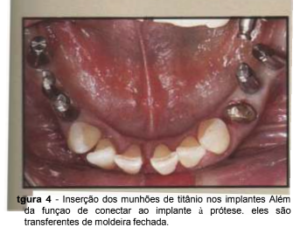 implantes de conexão sem parafuso