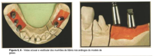 implantes de conexão sem parafuso