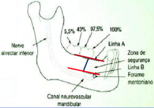 implantes de titânio curtos