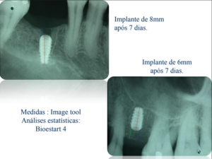 implantes de titânio curtos