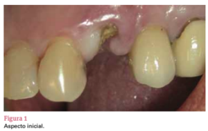 sistema de implante friccional