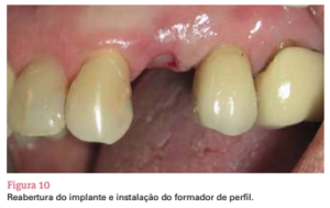 sistema de implante friccional