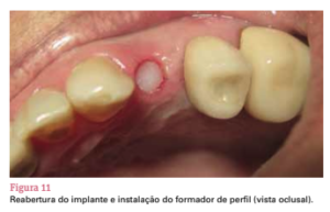 sistema de implante friccional