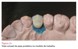 sistema de implante friccional