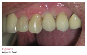 sistema de implante friccional