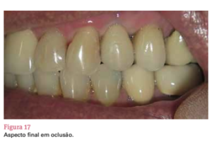 sistema de implante friccional