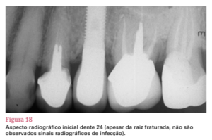 sistema de implante friccional