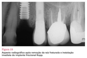 sistema de implante friccional