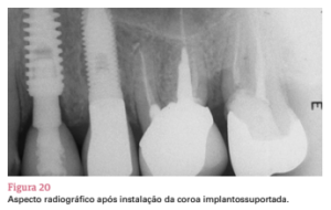 sistema de implante friccional