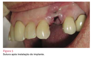 sistema de implante friccional