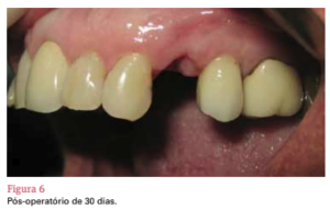 sistema de implante friccional