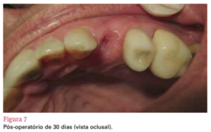 sistema de implante friccional