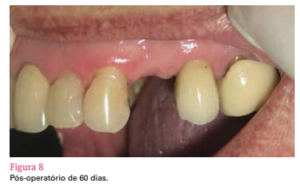 sistema de implante friccional