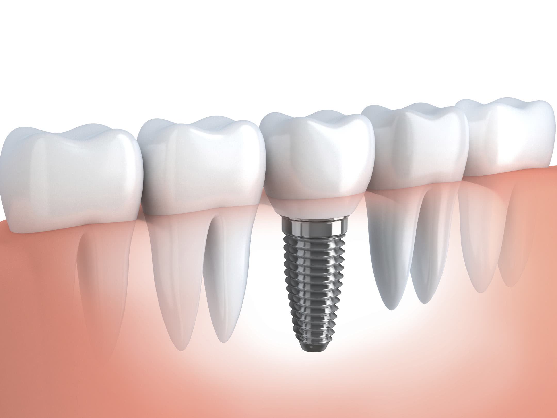 Avaliação Radiográfica de Implantes de Titânio Curtos em Maxilares Reabsorvidos de Pacientes Desdentados.