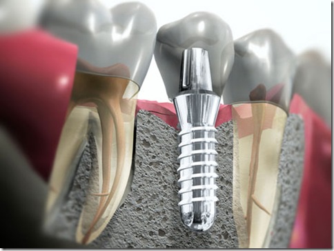 Influência do formato das roscas dos implantes na distribuição de tensões no tecido ósseo- análise fotoelástica.