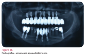 enxerto ósseo homólogo particulado modificada