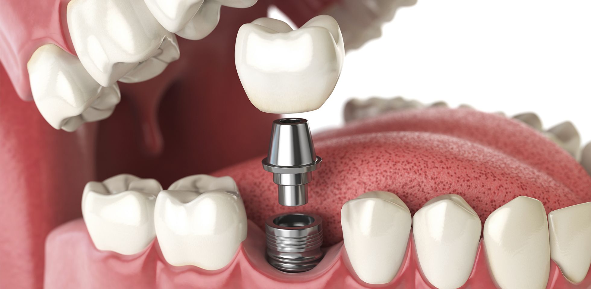 Avaliação da força de tração em intermediários de implantes dentários Tipo Locking Taper (estudo in vitro).