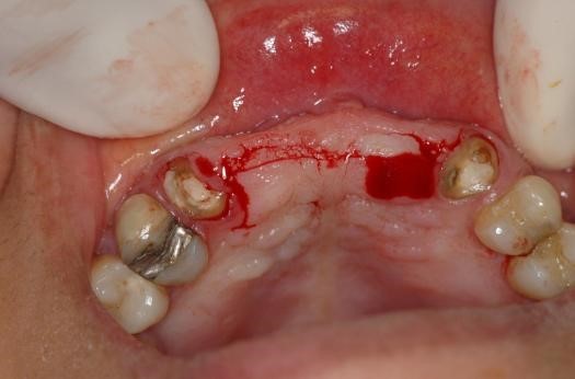 Incisão supracristal