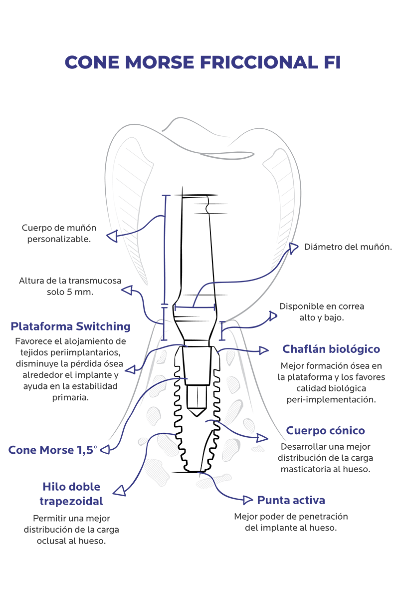 http://FI%20-%20Implant