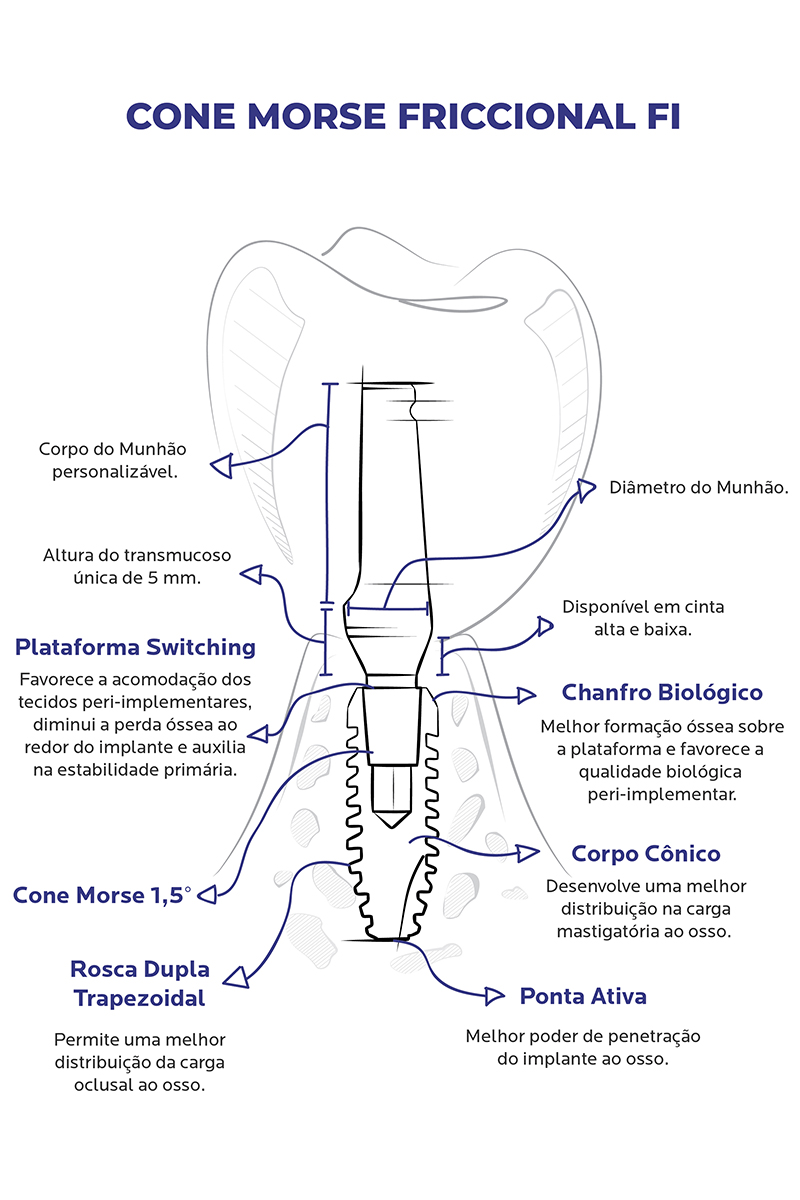 http://Ilustração_Implante_FI