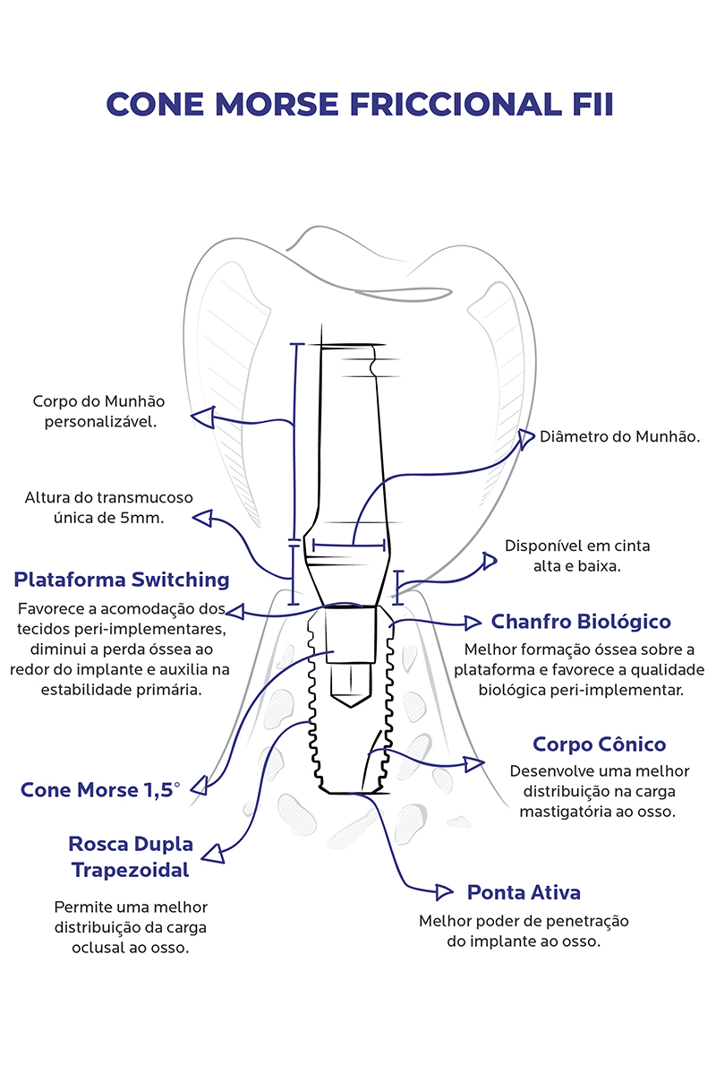 http://Ilustração_Implante_FII