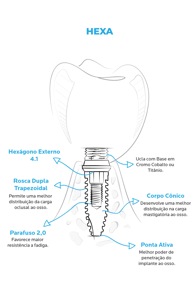 http://Ilustração_Implante_Hexa