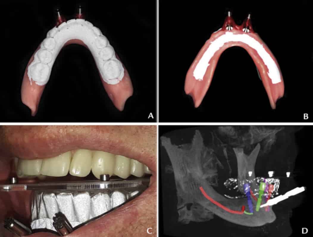 Guided implant surgery workflow in edentulous patients: A precise and rapid technique