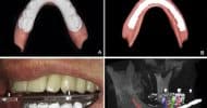 Guided implant surgery workflow in edentulous patients: A precise and rapid technique